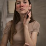 Acne and acne scar treatment in Dubai at Elite Style Polyclinic