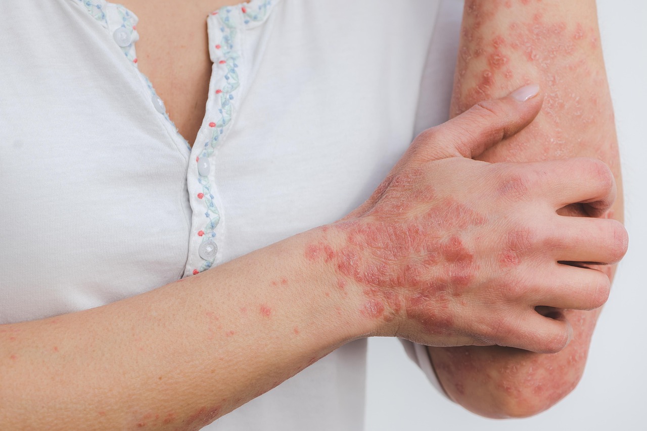Close-up of red, scaly, itchy skin patches on arms caused by eczema and psoriasis