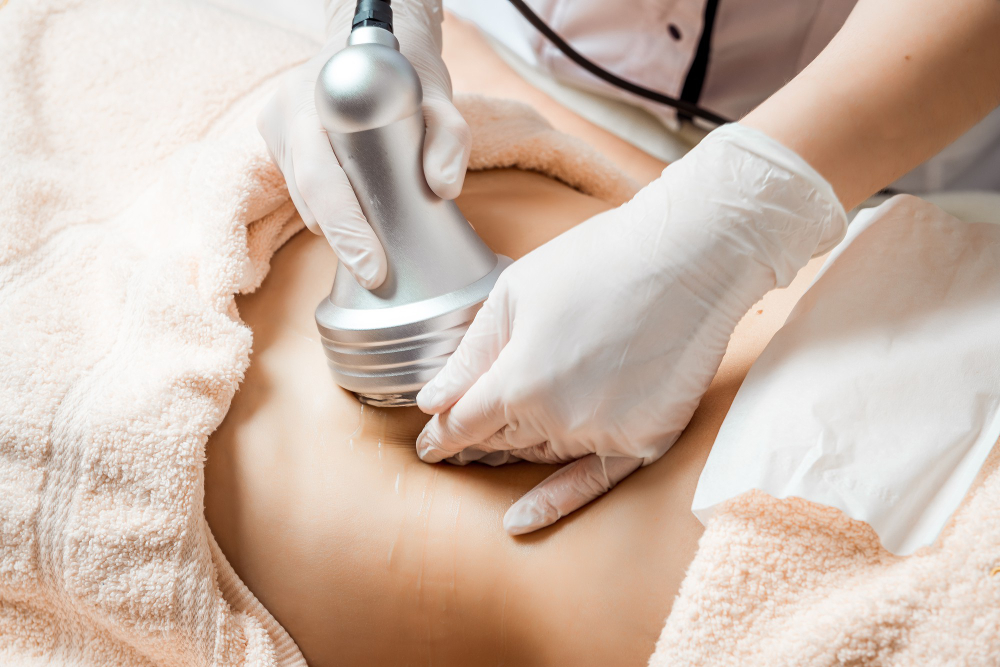 How EmTone Transforms Cellulite: Before and After Treatment Insights