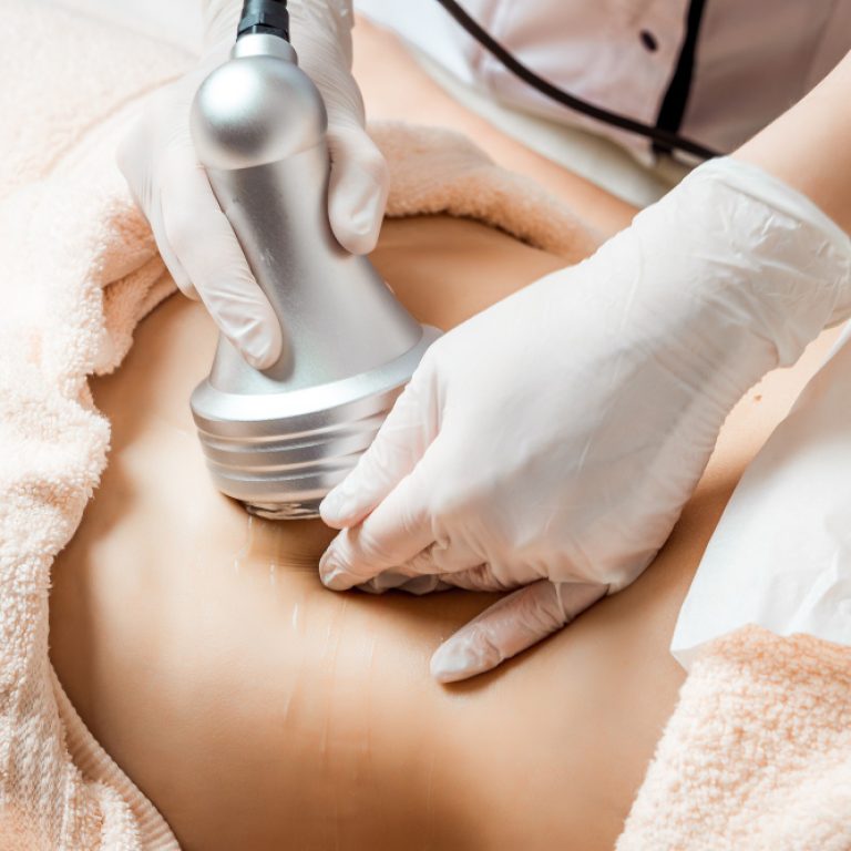 How EmTone Transforms Cellulite: Before and After Treatment Insights