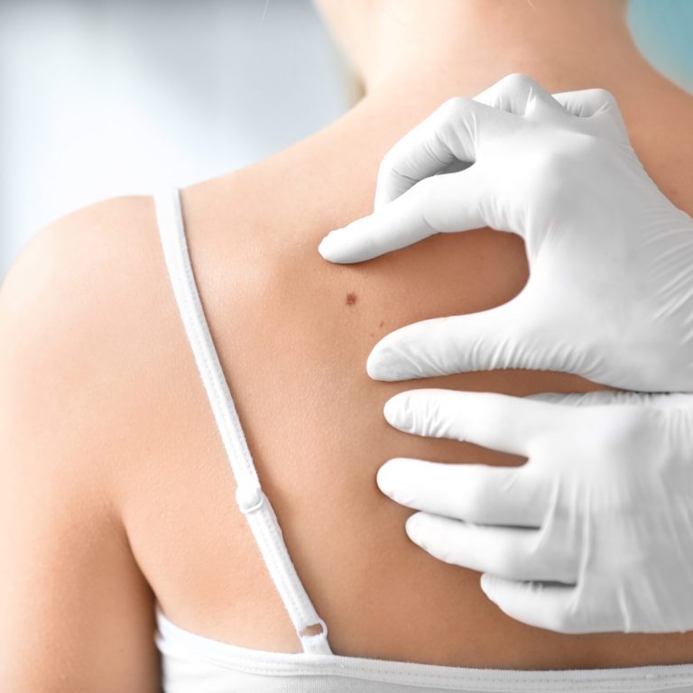 Dermatologist examining birthmark of patient, closeup. Cancer concept