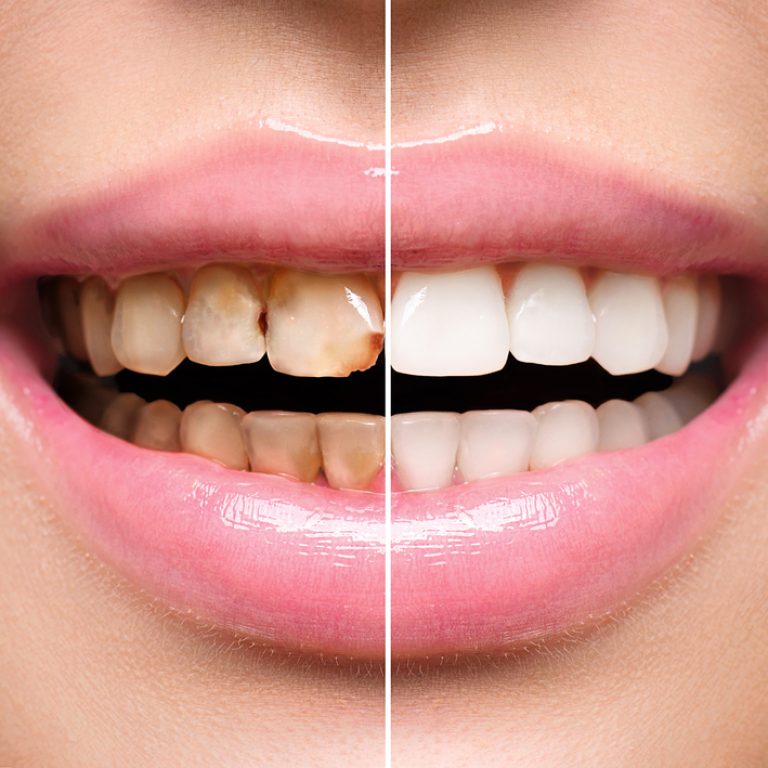 BleachingTeeth-Whitening