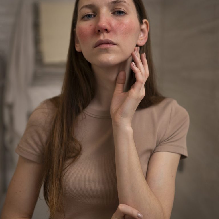 Acne and acne scar treatment in Dubai at Elite Style Polyclinic