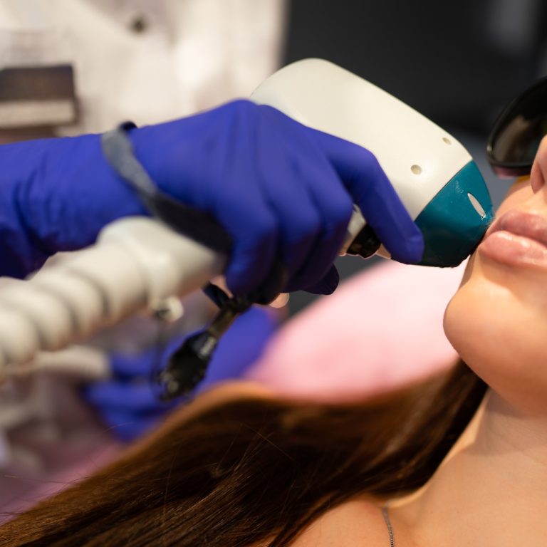 Face laser hair removal procedure