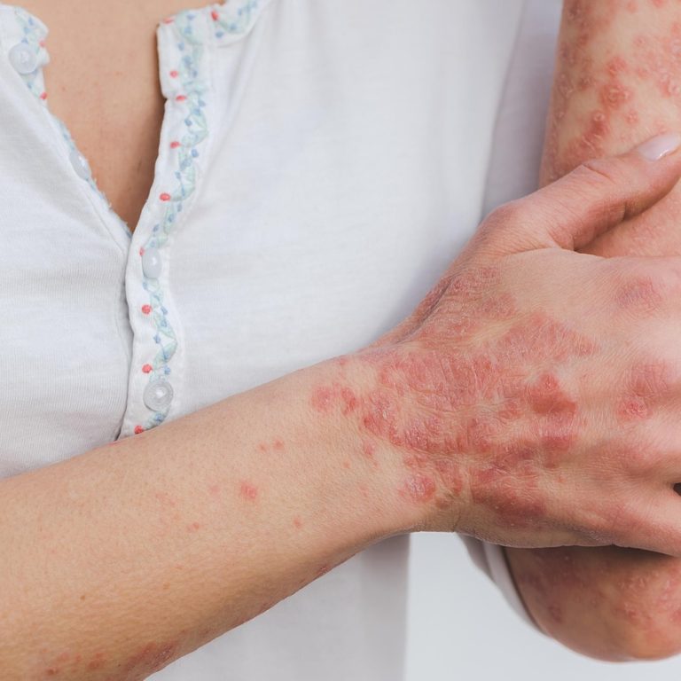 Close-up of red, scaly, itchy skin patches on arms caused by eczema and psoriasis