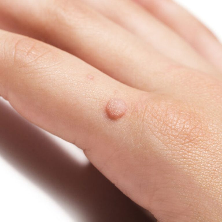 Common,Wart,Verruca,Vulgaris,A,Flat,Wart,Commonly,Found,On