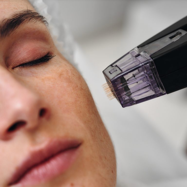 Woman receiving facial treatment with a microneedling device in clinic