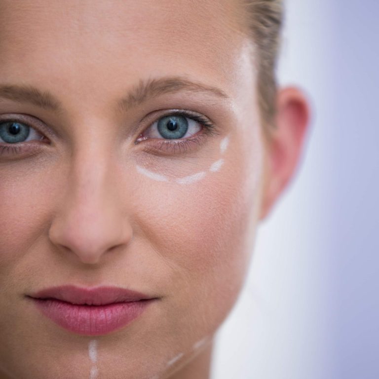 woman-with-marks-drawn-botox-procedure (1)